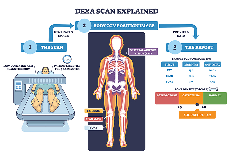 dexa scan